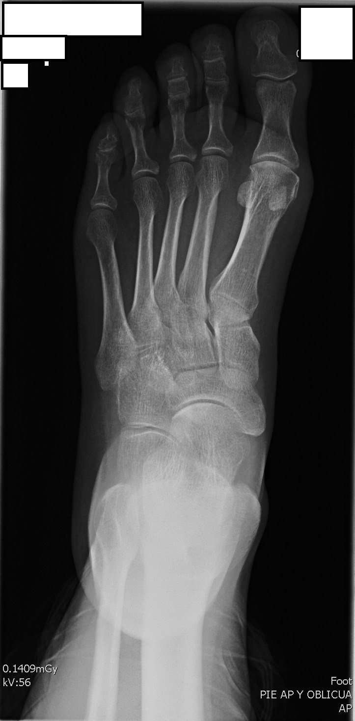 Posicionamiento AP de Pie